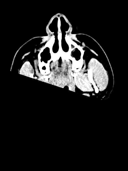 Normal trauma protocol brain and C-spine CT (Radiopaedia 83302-97709 Axial non-contrast 76).jpg