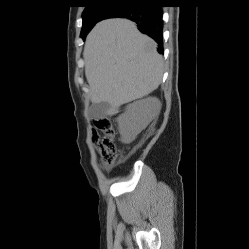 File:Obstructed kidney with perinephric urinoma (Radiopaedia 26889-27066 B 3).jpg