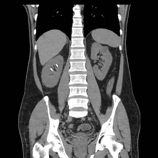 File:Obstructed kidney with perinephric urinoma (Radiopaedia 26889-27067 Coronal non-contrast 16).jpg