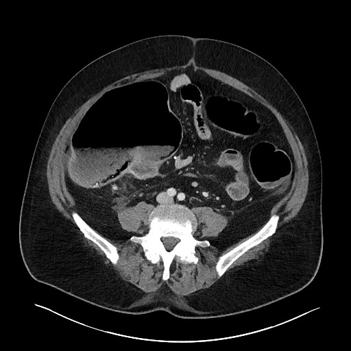 File:Obstructing sigmoid adenocarcinoma (Radiopaedia 58465-65619 A 107).jpg