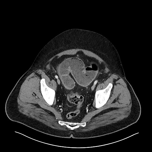 File:Obstructing sigmoid adenocarcinoma (Radiopaedia 58465-65619 A 141).jpg