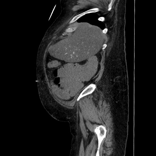 Obstructive colonic diverticular stricture (Radiopaedia 81085-94675 C 50).jpg