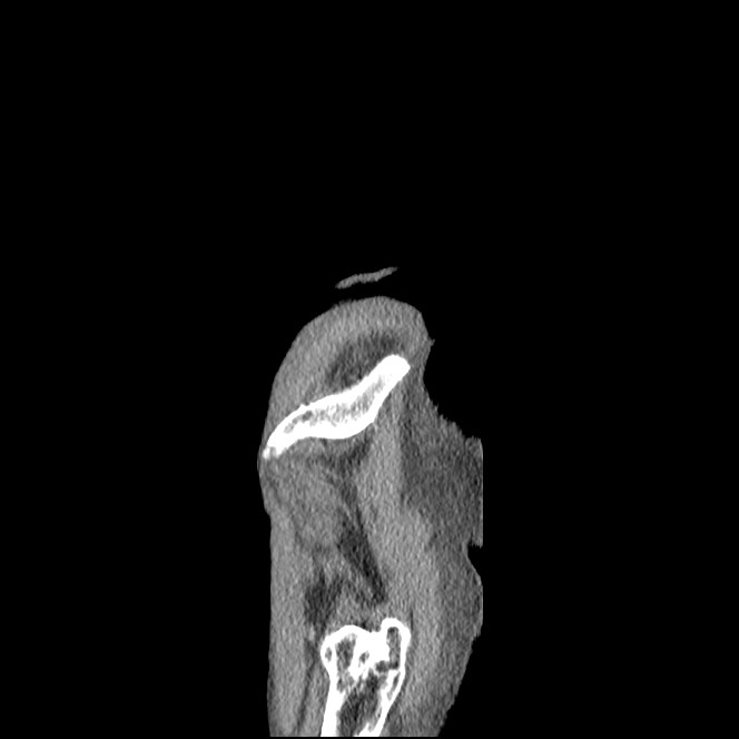 Obturator hernia causing small bowel obstruction (Radiopaedia 65522-74612 C 4).jpg