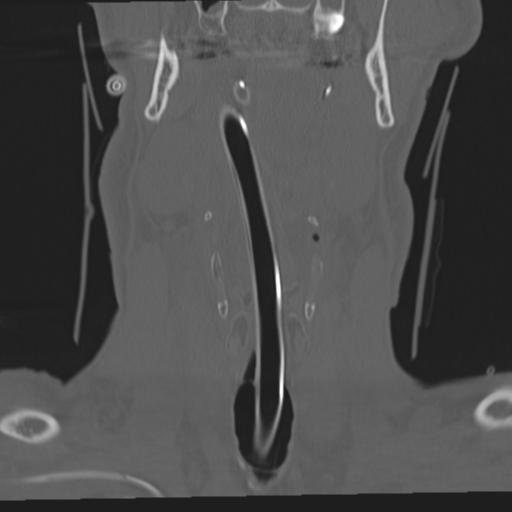 File:Occipital condyle fracture (Radiopaedia 33467-34517 Coronal bone window 4).png