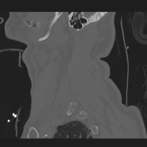 File:Occipital condyle fracture (Radiopaedia 33467-34517 Sagittal bone window 68).png