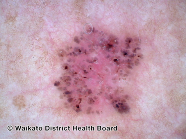 File:Polarised dermoscopy of pigmented basal cell carcinoma (DermNet NZ polarised-pigmented-bcc).jpg