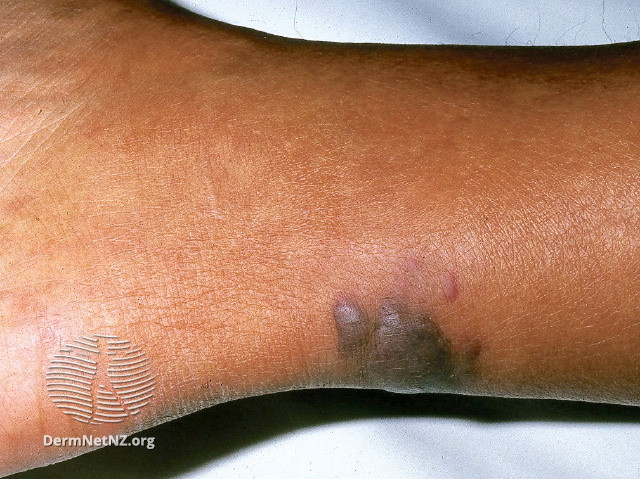 File:Thrombosed angiokeratoma (DermNet NZ angiokeratoma-56).jpg