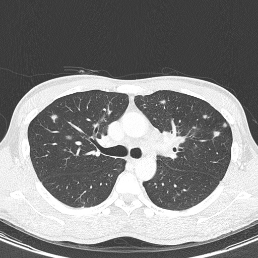 AIDS-related Kaposi sarcoma (Radiopaedia 85247-100811 Axial lung window 60).jpg
