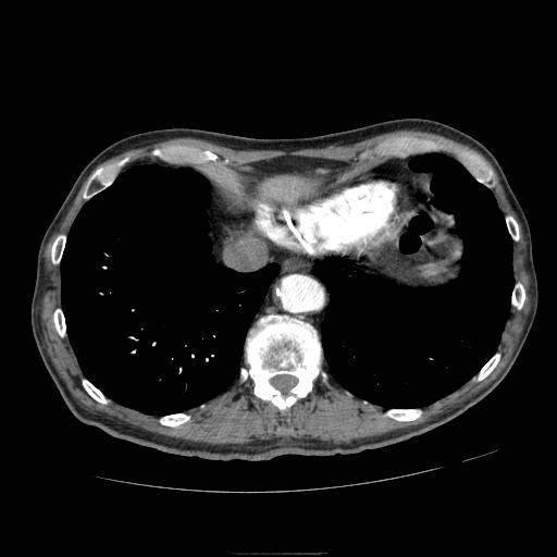 Abdominal aortic aneurysm (Radiopaedia 13341-13340 Axial C+ arterial phase 9).jpg