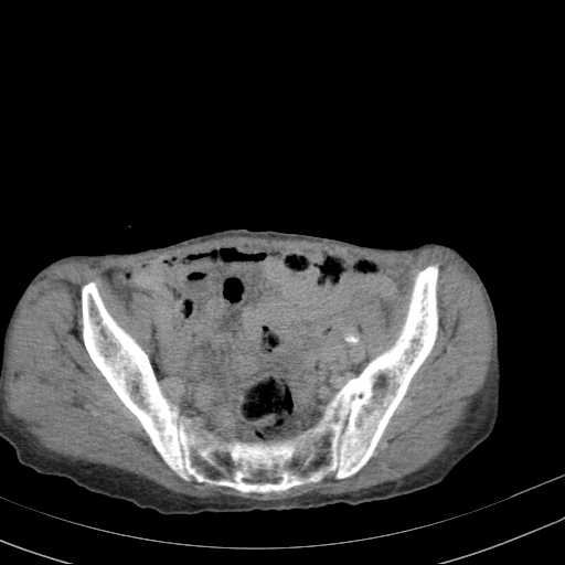 File:Abdominal aortic aneurysm (Radiopaedia 20827-20742 Axial C+ delayed 29).jpg