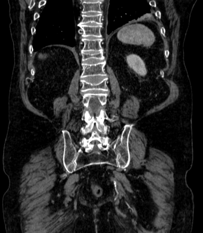Abdominal aortic aneurysm (Radiopaedia 25855-26001 Coronal C+ arterial phase 62).jpg