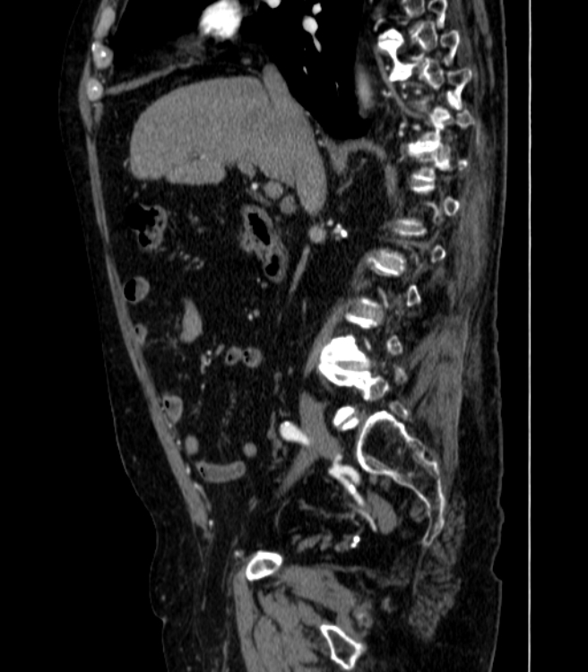 Abdominal aortic aneurysm (Radiopaedia 25855-26001 Sagittal C+ arterial phase 12).jpg