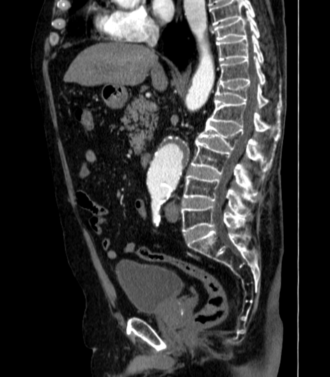 Abdominal aortic aneurysm (Radiopaedia 25855-26001 Sagittal C+ arterial phase 24).jpg