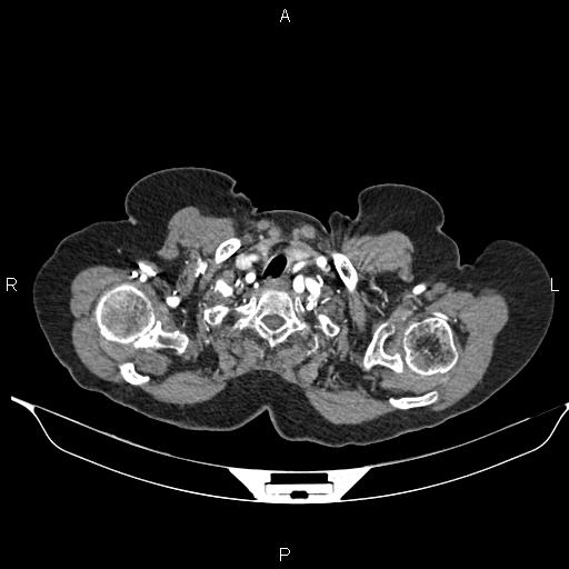 File:Abdominal aortic aneurysm (Radiopaedia 85063-100606 Axial C+ arterial phase 5).jpg