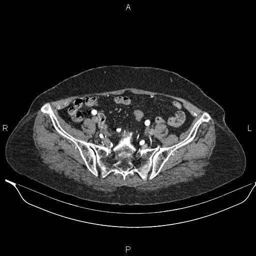 File:Abdominal aortic aneurysm (Radiopaedia 85063-100606 Axial C+ arterial phase 55).jpg