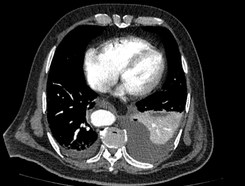 Abdominal aortic aneurysm rupture (Radiopaedia 54179-60362 Axial C+ arterial phase 16).jpg