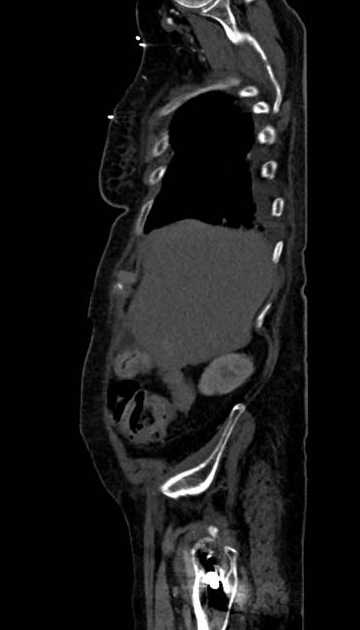 Abdominal aortic aneurysm with thrombus fissuration (Radiopaedia 73192-83919 Sagittal C+ arterial phase 122).jpg