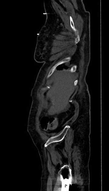 Abdominal aortic aneurysm with thrombus fissuration (Radiopaedia 73192-83919 Sagittal C+ arterial phase 131).jpg