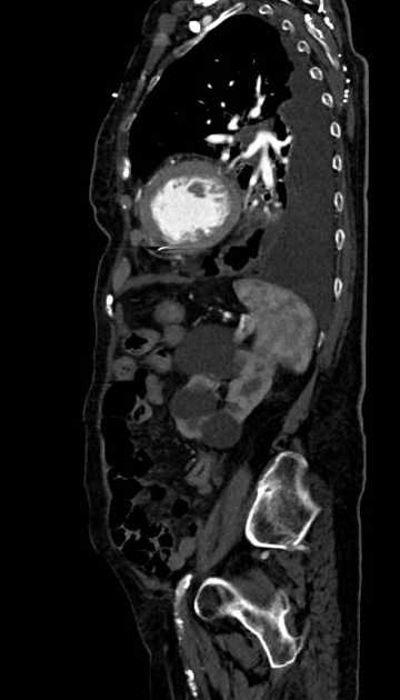 Abdominal aortic aneurysm with thrombus fissuration (Radiopaedia 73192-83919 Sagittal C+ arterial phase 35).jpg