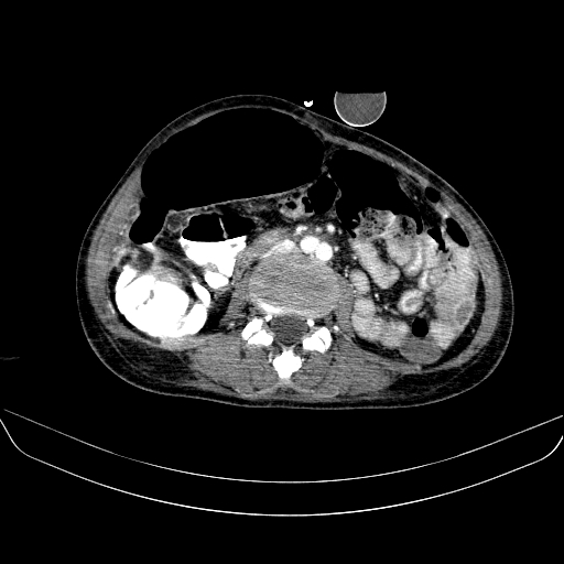 File:Abdominal collection due to previous cecal perforation (Radiopaedia 80831-94320 Axial C+ portal venous phase 110).jpg