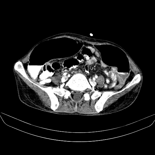 File:Abdominal collection due to previous cecal perforation (Radiopaedia 80831-94320 Axial C+ portal venous phase 141).jpg