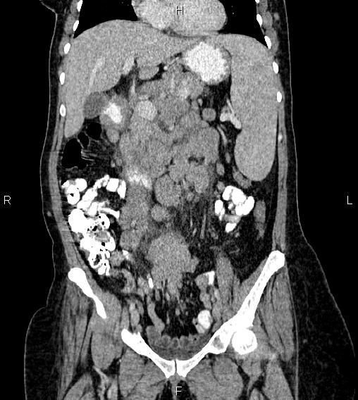 Abdominal lymphoma with sandwich sign (Radiopaedia 84378-99704 Coronal C+ portal venous phase 24).jpg