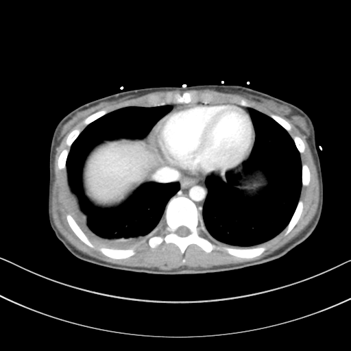 File:Abdominal multi-trauma - devascularised kidney and liver, spleen and pancreatic lacerations (Radiopaedia 34984-36486 Axial C+ portal venous phase 6).png