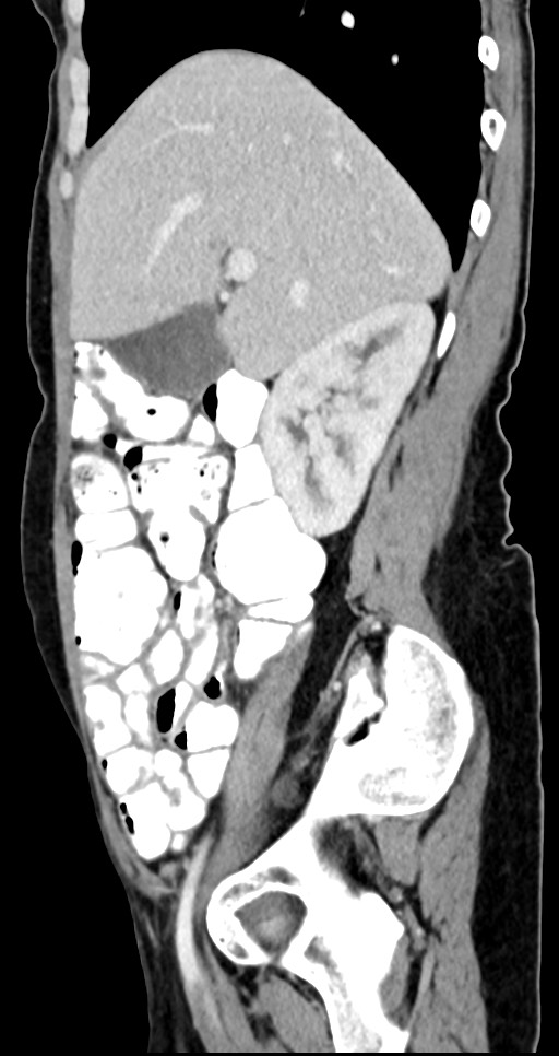 Abdominal wall and retroperitoneal tuberculosis (Radiopaedia 88137-104729 Sagittal C+ portal venous phase 104).jpg
