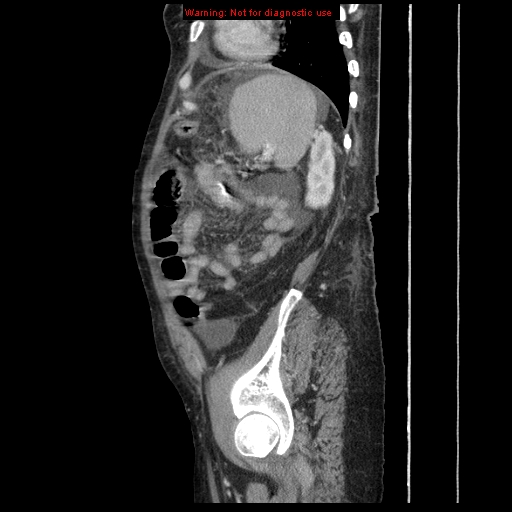 Abdominal wall hematoma (Radiopaedia 9427-10112 Sagittal C+ portal venous phase 25).jpg