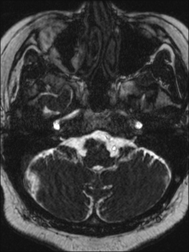 File:Abducens nerve palsy (Radiopaedia 57084-63976 Axial T2 ciss 3d 15).jpg