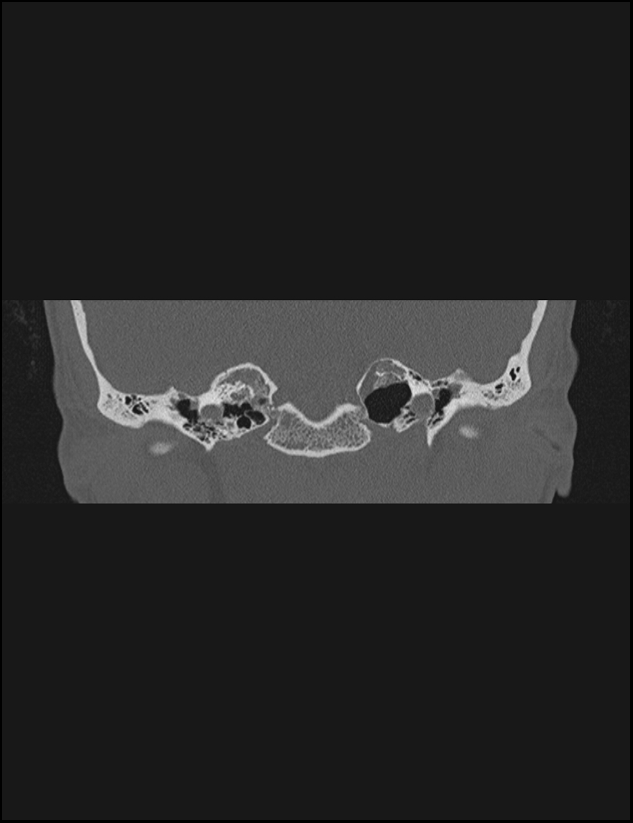 Aberrant right internal carotid artery (Radiopaedia 65191-74198 Coronal non-contrast 34).jpg