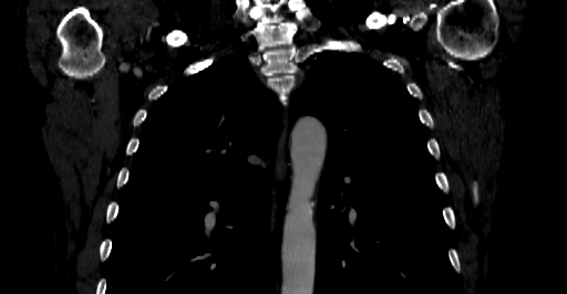 File:Accesory rib joint (Radiopaedia 71987-82452 Coronal bone window 7).jpg