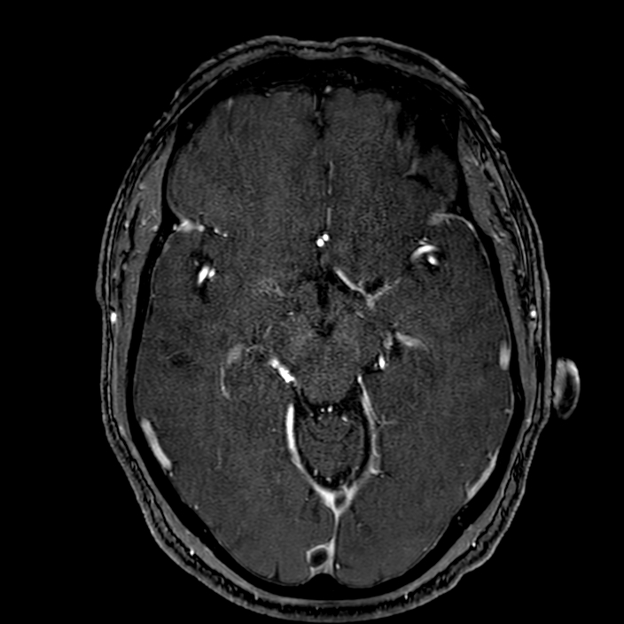 Accessory middle cerebral artery (Radiopaedia 73114-83828 Axial MRA 81).jpg