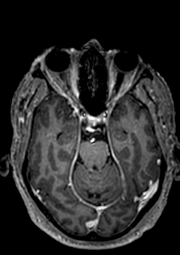 Accessory middle cerebral artery (Radiopaedia 73114-83828 Axial T1 C+ 91).jpg