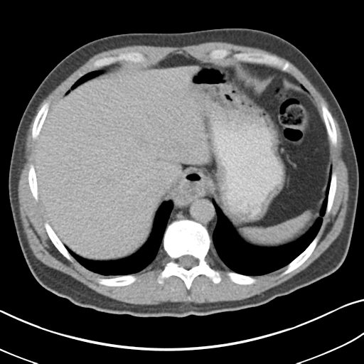 File:Achalasia of the cardia (Radiopaedia 38497-40595 Axial C+ portal venous phase 15).png