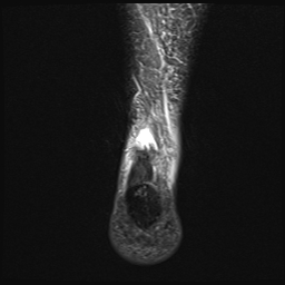 File:Achilles tendon tear (Radiopaedia 77615-89819 Coronal STIR 24).jpg