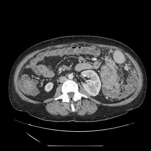 Acinar cell carcinoma of the pancreas (Radiopaedia 75442-86669 Axial C+ portal venous phase 74).jpg