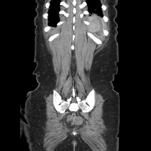 Acinar cell carcinoma of the pancreas (Radiopaedia 75442-86669 Coronal C+ portal venous phase 111).jpg