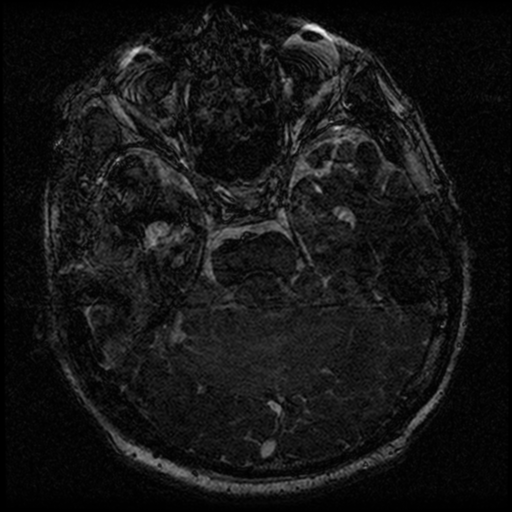 File:Acoustic schwannoma (Radiopaedia 39170-41387 Axial FIESTA 101).png