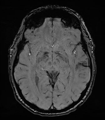Acoustic schwannoma (Radiopaedia 50846-56358 Axial SWI 44).png