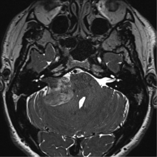File:Acoustic schwannoma (Radiopaedia 50846-56358 Axial T2 21).png