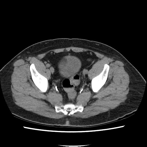 File:Active colonic bleed on CT (Radiopaedia 49765-55025 Axial non-contrast 71).jpg