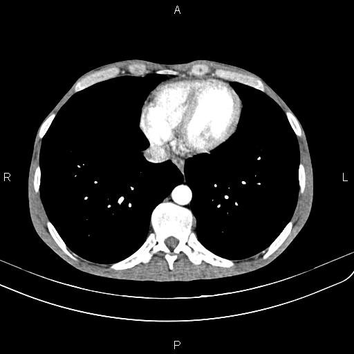 Active crohn disease (Radiopaedia 87133-103397 Axial C+ arterial phase 7).jpg