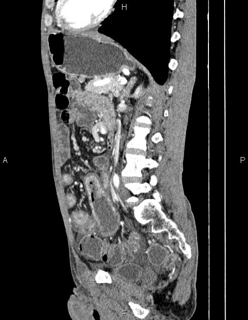Active crohn disease (Radiopaedia 87133-103397 Sagittal C+ arterial phase 55).jpg