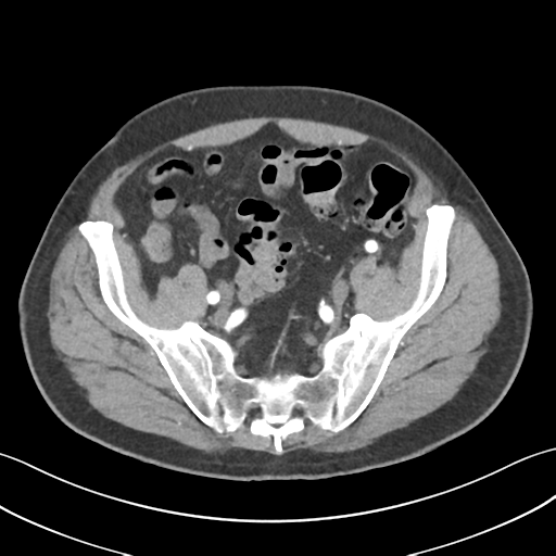 File:Active diverticular hemorrhage (Radiopaedia 39415-41725 Axial C+ arterial phase 52).png