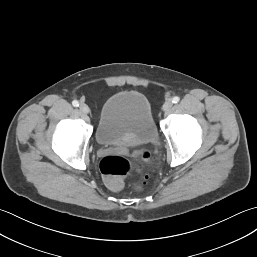 File:Active diverticular hemorrhage (Radiopaedia 39415-41725 Axial C+ portal venous phase 64).png