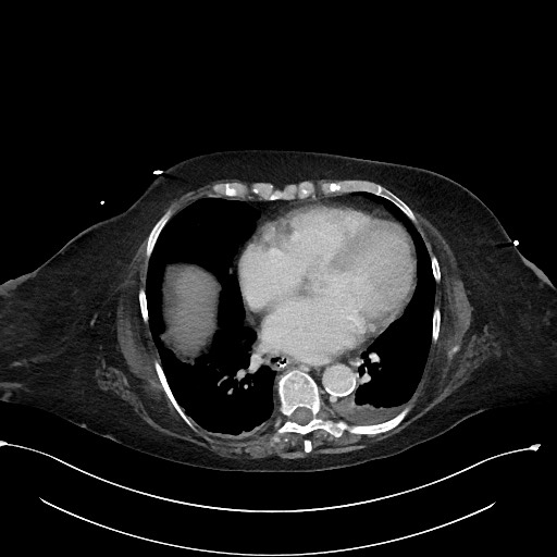 File:Active renal extravasation with large subcapsular and retroperitoneal hemorrhage (Radiopaedia 60975-68796 Axial 359).jpg