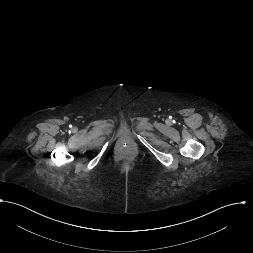 Active renal extravasation with large subcapsular and retroperitoneal hemorrhage (Radiopaedia 60975-68796 Axial C+ arterial phase 213).jpg