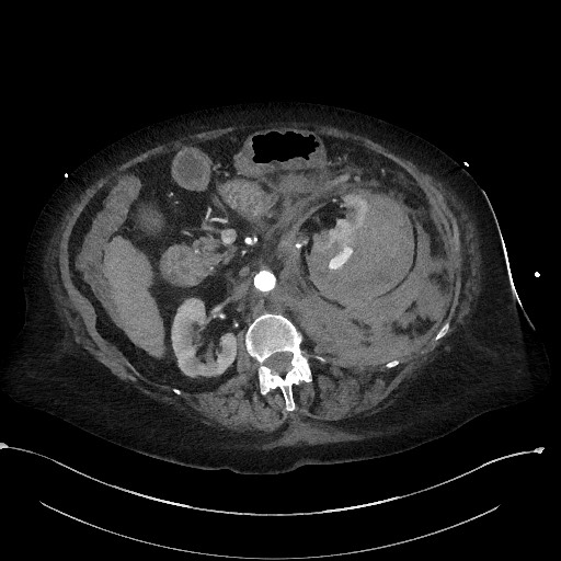 Active renal extravasation with large subcapsular and retroperitoneal hemorrhage (Radiopaedia 60975-68796 Axial C+ arterial phase 79).jpg