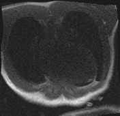 Active right ventricular cardiac sarcoidosis (Radiopaedia 55596-62100 Axial Dynamic perfusion scan MOCO 10).jpg